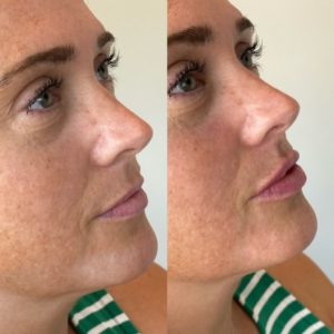 filler before and after | skin care | Novique Medical Aesthetics | Doylestown, PA