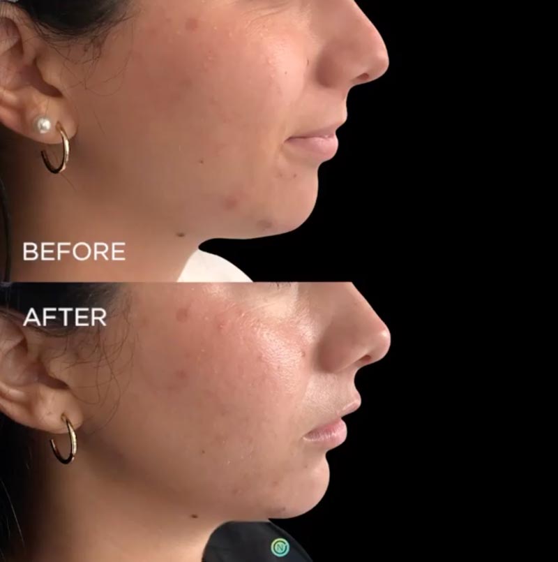 filler treatment before and after | skin care | Novique Medical Aesthetics | Doylestown, PA