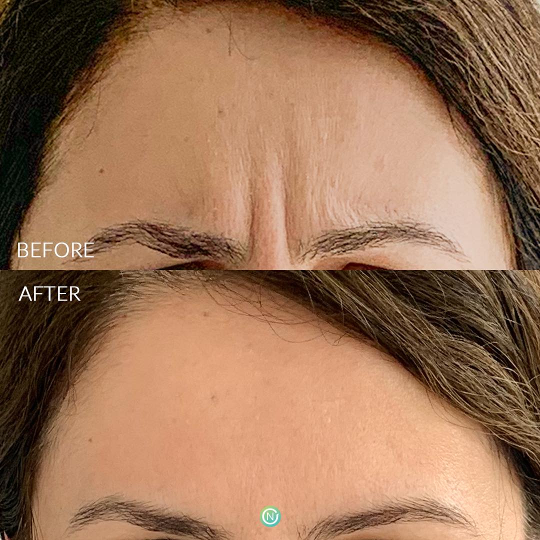 filler before and after treatment | skin care | Novique Medical Aesthetics | Doylestown, PA