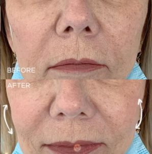 juvederm treatment before and after | skin care | Novique Medical Aesthetics | Doylestown, PA
