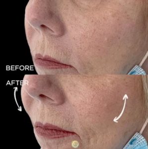 juvederm befire and after | skin care | Novique Medical Aesthetics | Doylestown, PA