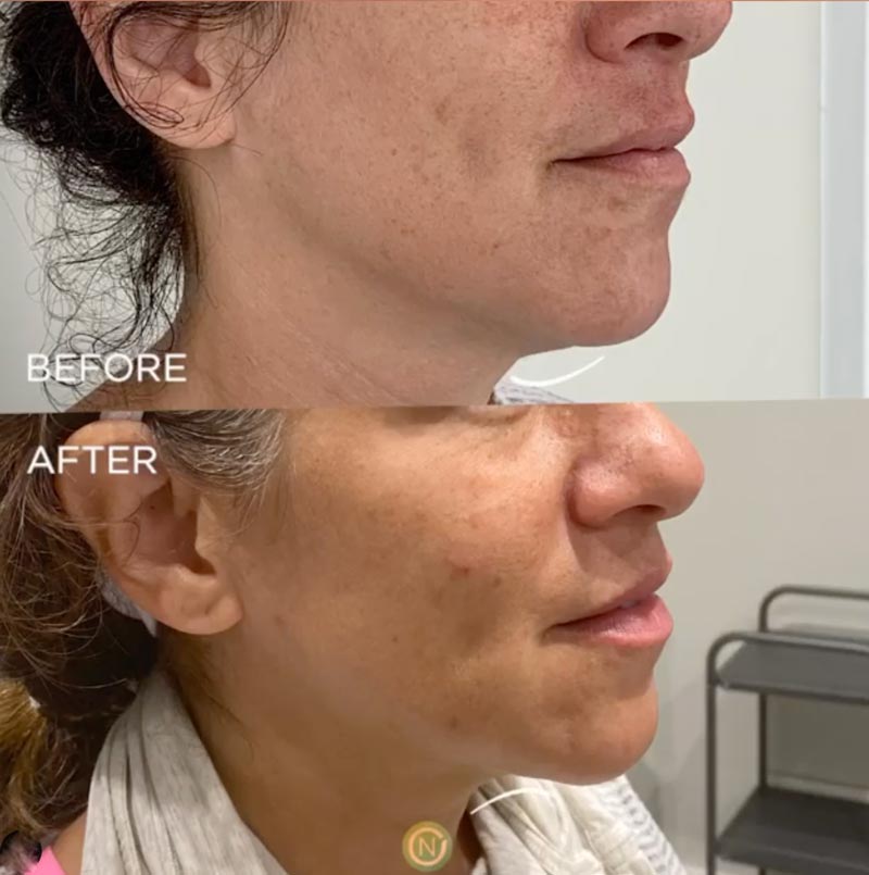 morpheus 8 skin tightening before and after | skin care | Novique Medical Aesthetics | Doylestown, PA