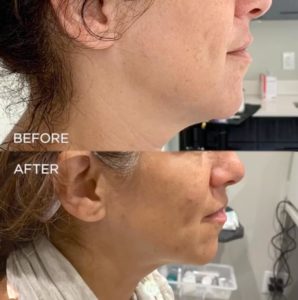 morpheus 8 skin tightening before and after | skin care | Novique Medical Aesthetics | Doylestown, PA