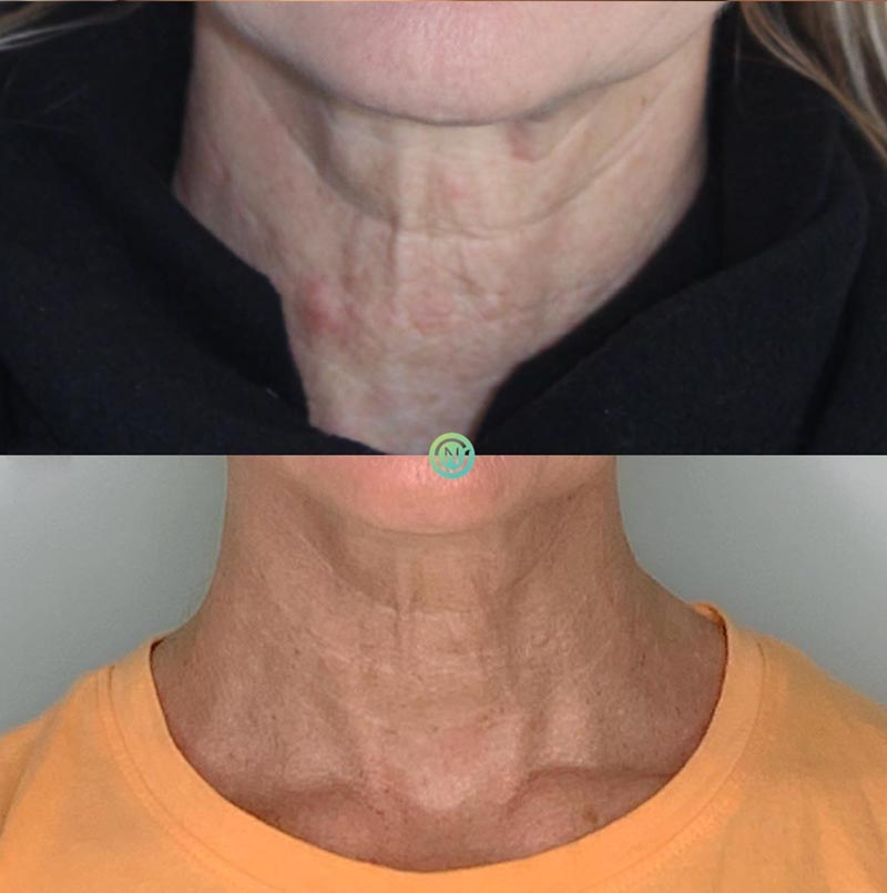 Morpheus 8 skin tightening | skin care | Novique Medical Aesthetics | Doylestown, PA