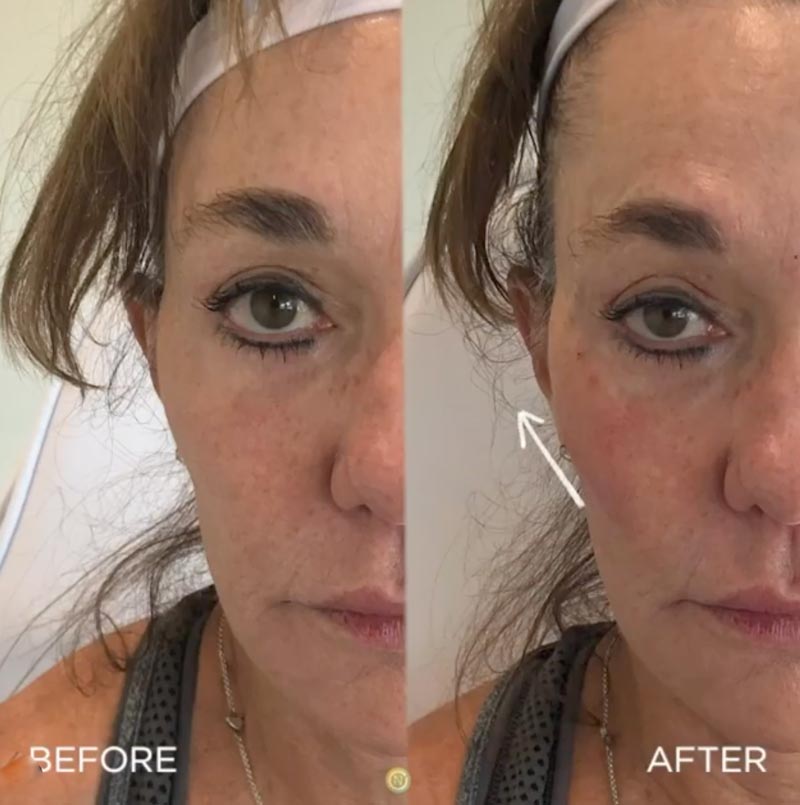 juvederm before and after | skin care | Novique Medical Aesthetics | Doylestown, PA