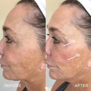 Juvederm before and after | skin care | Novique Medical Aesthetics | Doylestown, PA