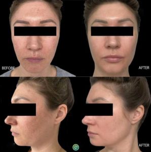 Skin rejuvenation treatment before and after | skin care | Novique Medical Aesthetics | Doylestown, PA