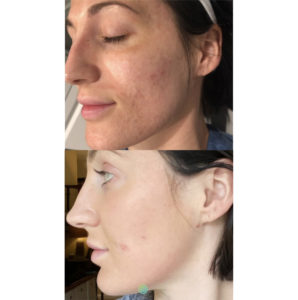 Juvederm before and after | skin care | Novique Medical Aesthetics | Doylestown, PA