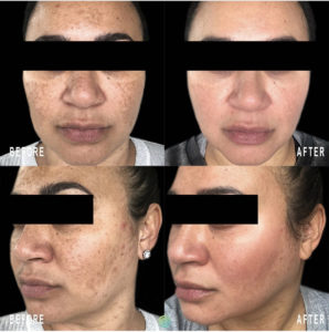 Professional depigmenting treatment designed to eliminate or reduce dark spots | skin care | Novique Medical Aesthetics | Doylestown, PA