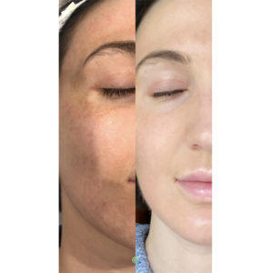 Juvederm before and after | skin care | Novique Medical Aesthetics | Doylestown, PA