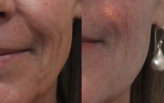 Morpheus 8 by InMode takes skin rejuvenation to a whole new level with microneedling combined with radiofrequency (RF) energy. | skin care | Novique Medical Aesthetics | Doylestown, PA