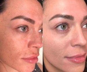The REVEPEEL® is a true medium depth peel works to repair skin at cellular level with integrated pre and post peel treatment | skin care | Novique Medical Aesthetics | Doylestown, PA
