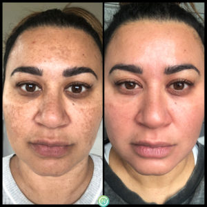 Skin hyperpigmentation is caused by abnormal production of melanin | skin care | Novique Medical Aesthetics | Doylestown, PA