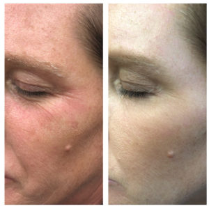 DiamondGlow Before and after | skin care | Novique Medical Aesthetics | Doylestown, PA