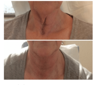 Skin tightening | skin care | Novique Medical Aesthetics | Doylestown, PA