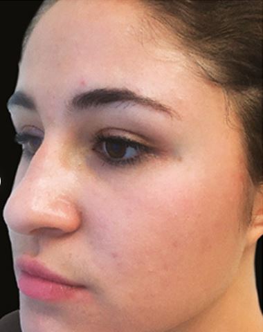 DiamondGlow after | skin care | Novique Medical Aesthetics | Doylestown, PA