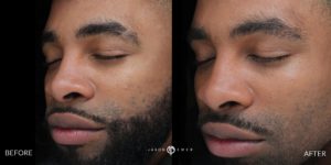before and after acne removal treatment patient 3 | skin care | Novique Medical Aesthetics | Doylestown, PA