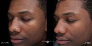 before and after acne removal treatment patient 4 | skin care | Novique Medical Aesthetics | Doylestown, PA