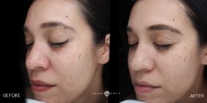 before and after acne removal treatment patient 2 | skin care | Novique Medical Aesthetics | Doylestown, PA