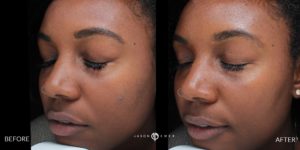 before and after acne removal treatment patient 1 | skin care | Novique Medical Aesthetics | Doylestown, PA