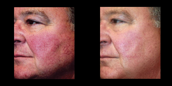 Before and after with his facial treatment | | skin care | Novique Medical Aesthetics | Doylestown, PA