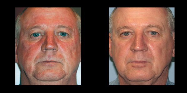 before and after frontal view with his facial treatment | skin care | Novique Medical Aesthetics | Doylestown, PA