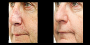 photos of the patient before and after with his facial treatment | skin care | Novique Medical Aesthetics | Doylestown, PA