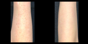 Showing before and after skin treatment | skin care | Novique Medical Aesthetics | Doylestown, PA