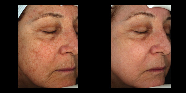 before and after skin treatment | skin care | Novique Medical Aesthetics | Doylestown, PA