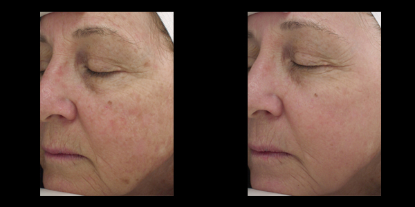 Halo skin acne removal treatment patient 7 | skin care | Novique Medical Aesthetics | Doylestown, PA