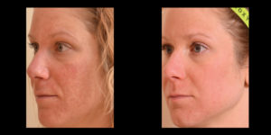 Halo skin acne removal treatment patient 6 | skin care | Novique Medical Aesthetics | Doylestown, PA
