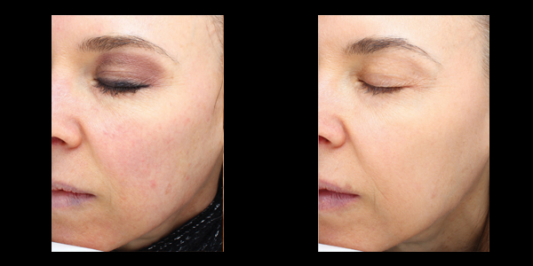 Halo skin acne removal treatment patient 5 | skin care | Novique Medical Aesthetics | Doylestown, PA