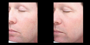 Halo skin acne removal treatment patient 2 | skin care | Novique Medical Aesthetics | Doylestown, PA