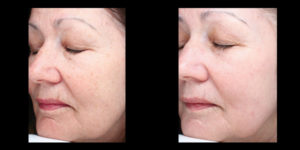 Halo skin acne removal treatment patient 1 | skin care | Novique Medical Aesthetics | Doylestown, PA