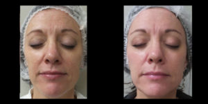 Halo skin acne removal treatment patient 4 | skin care | Novique Medical Aesthetics | Doylestown, PA