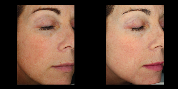 Halo skin acne removal treatment patient 3 | skin care | Novique Medical Aesthetics | Doylestown, PA