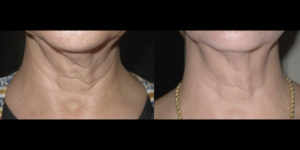 skin resurfacing patient 2 | skin tightening | Novique Medical Aesthetics | Doylestown, PA