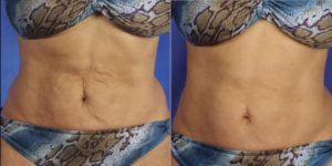 body shape patient 2 | body contouring | Novique Medical Aesthetics | Doylestown, PA