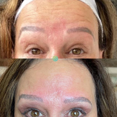 botox-before-and-after-01