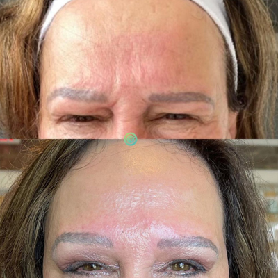 botox-before-and-after-02