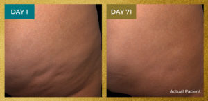Before and after result QWO | Skin Tightening | Novique Medical Aesthetic | Doylestown, PA