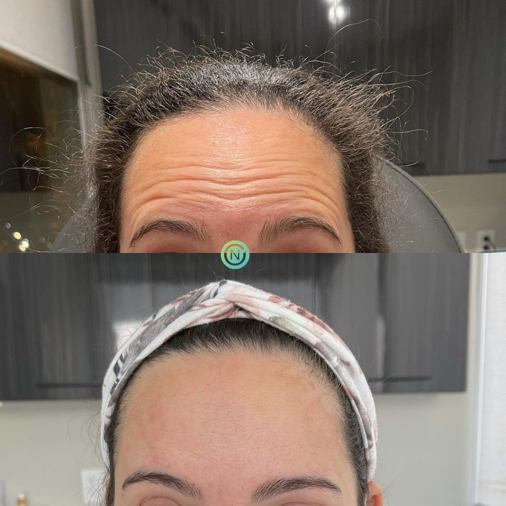 botoxbeforeandafter07a Novique Medical Aesthetics