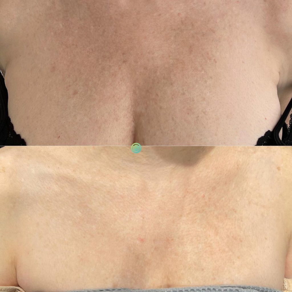 Before and after images showcasing skin texture improvements on the chest area. The top image displays uneven skin tone with visible blemishes and slight redness, while the bottom image reveals smoother, more even skin with reduced imperfections. These images highlight the effectiveness of a skincare treatment designed to enhance skin clarity and overall appearance. Ideal for those seeking solutions for skin rejuvenation and texture refinement.