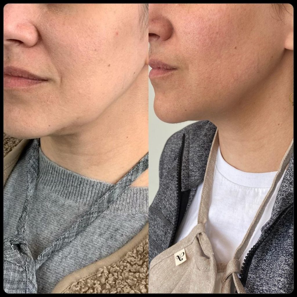 Side-by-side comparison of a woman's jawline and neck, showcasing different skin textures and tones. The left side features a close-up with natural light highlighting subtle skin imperfections, while the right side presents a smoother appearance under bright lighting. Both images emphasize the differences in skin condition, with the woman wearing casual, layered clothing in a neutral color palette. This visual aids discussions on skincare routines and the effects of lighting on skin appearance.