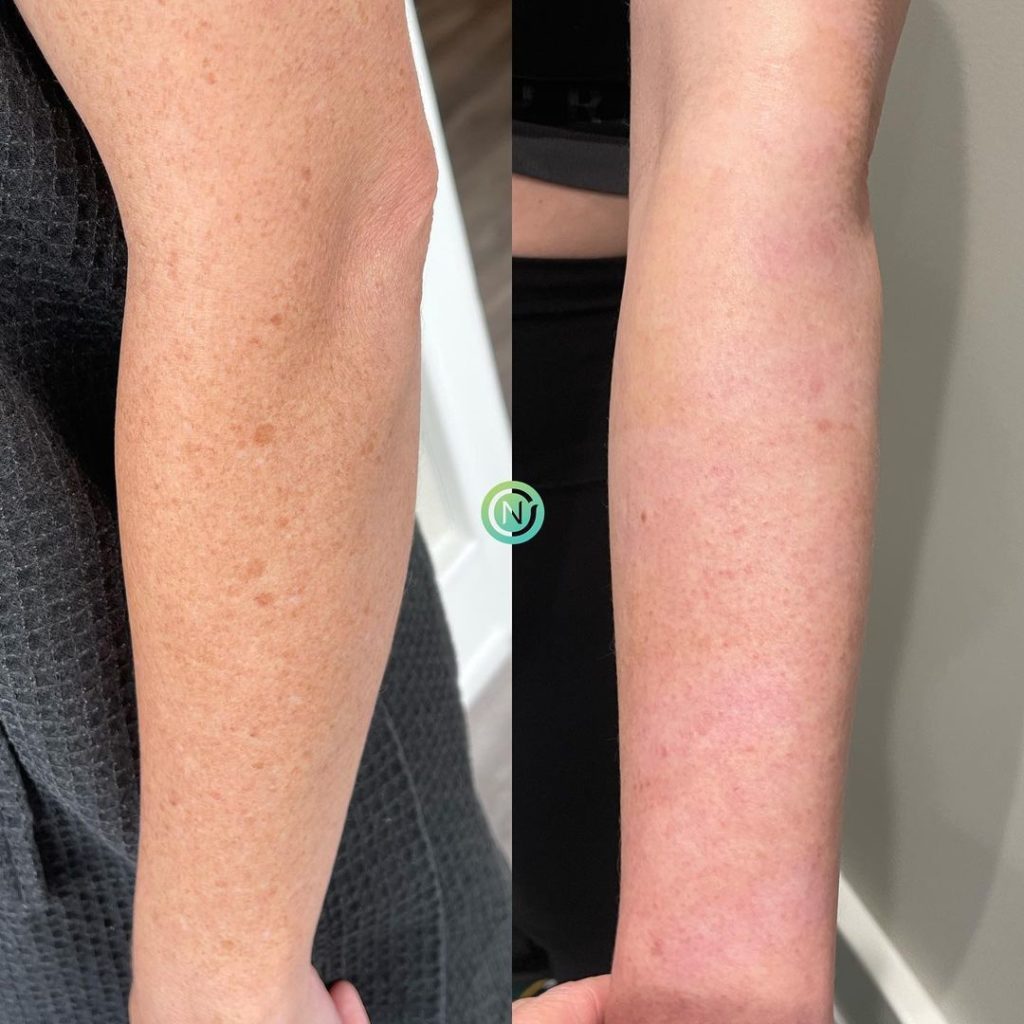 Before and after image showing the skin on a woman's arms. The left arm displays visible sunspots and uneven pigmentation, while the right arm appears smoother and more even-toned, indicating successful skin treatment. The background features a neutral wall, enhancing the focus on the arms. This image highlights the effectiveness of skin care solutions for pigmentation issues.