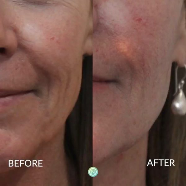 Filler treatment before and after | skin care | Novique Medical Aesthetics | Doylestown, PA