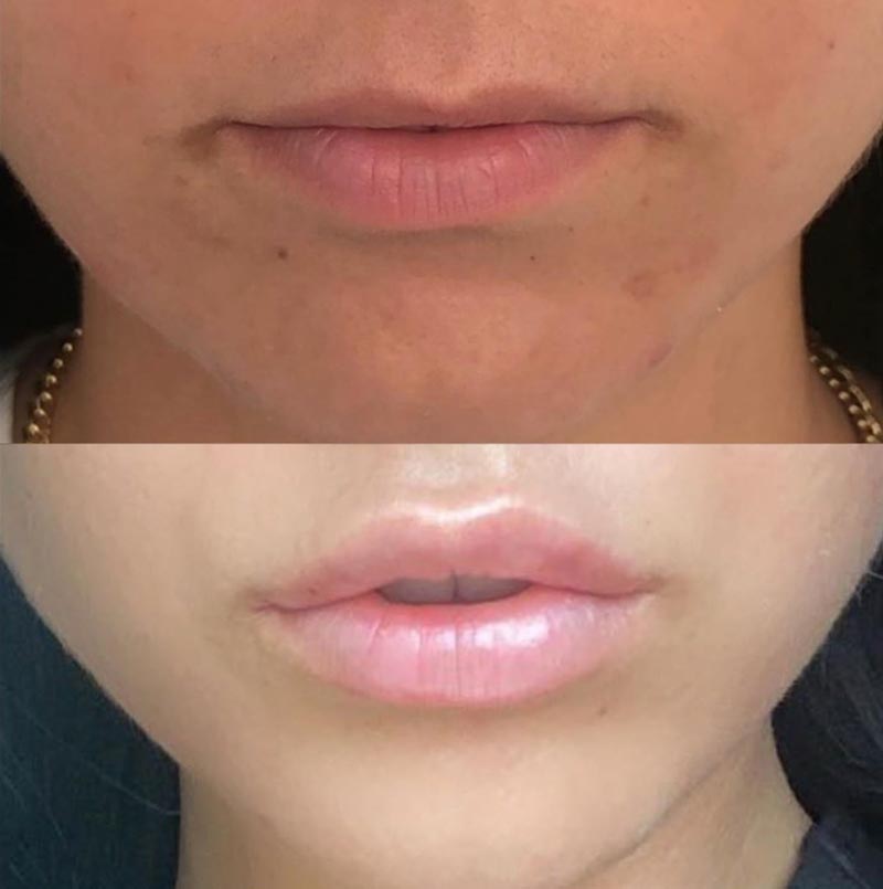 filler before and after | skin care | Novique Medical Aesthetics | Doylestown, PA