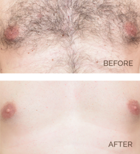 Chest Hair Removal Before and After | Novique | Aesthetic Treatments | Doylestown & Bethlehem PA