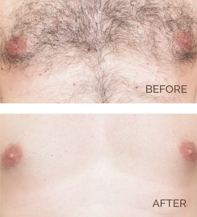 Chest Hair Removal Before and After | Novique | Aesthetic Treatments | Doylestown & Bethlehem PA