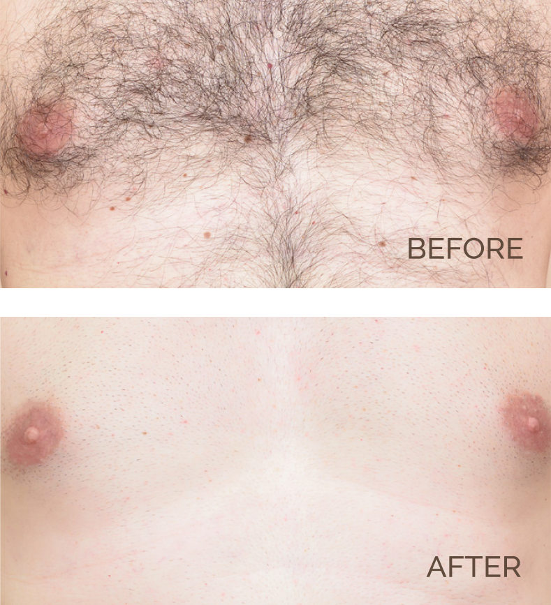 Chest Hair Removal Before and After | Novique | Aesthetic Treatments | Doylestown & Bethlehem PA